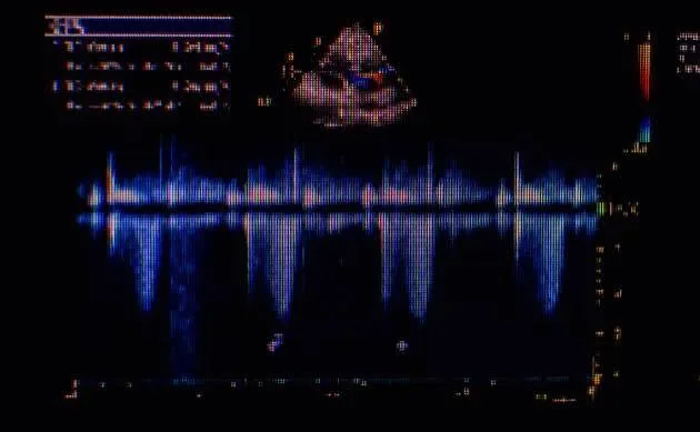Schermo dell'ecodoppler con il tracciato del flusso sanguigno in blu e, in alto, l'immagine ecografica a colori